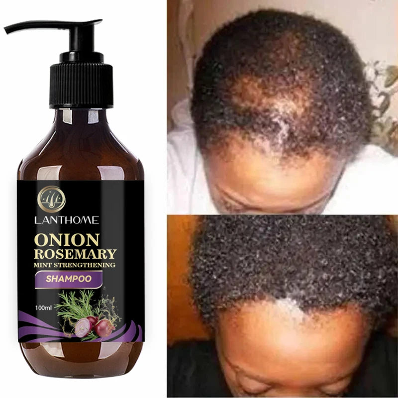 FAST!! Hair Growth Rosemary Onion Hair Regrowth Shampoo/Spray